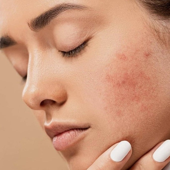 Peau à tendance acnéique